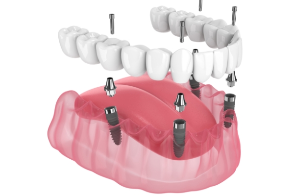 オールオン4、オールオン6