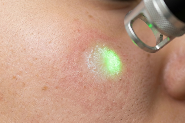 3. ヤグレーザー治療