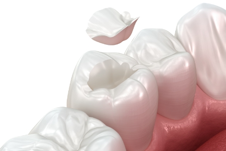 セラミック（審美治療）