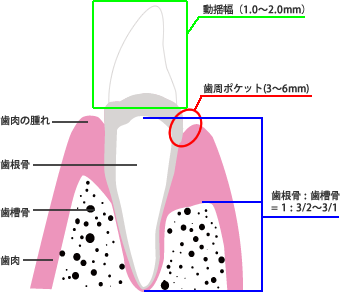 中等度歯周病の症状・診断