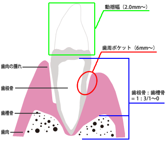 重度歯周病の症状・診断
